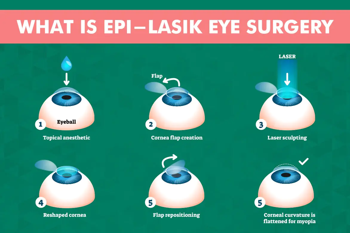 LASIK Surgery